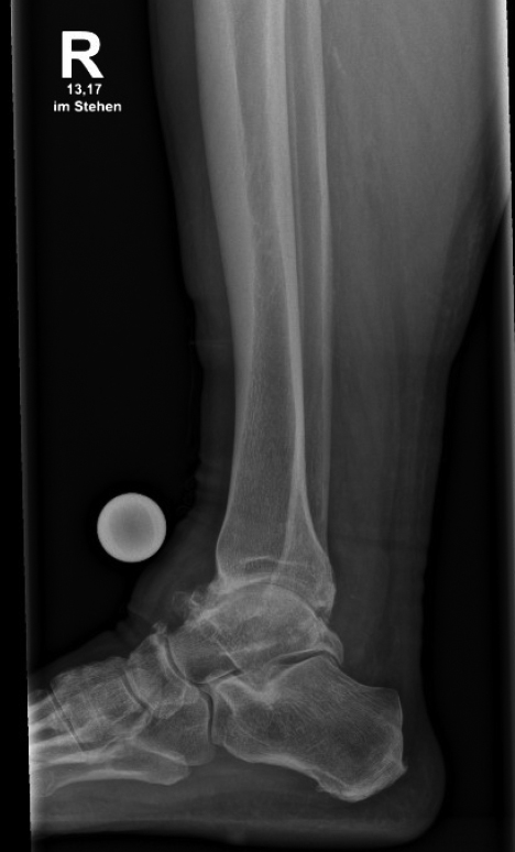 Röntgenaufnahme des rechten Sprunggelenks im seitlichen Standbild zur medizinischen Untersuchung.